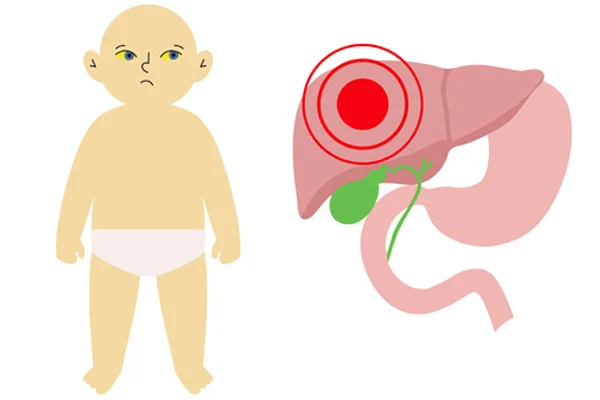 Cholestasis