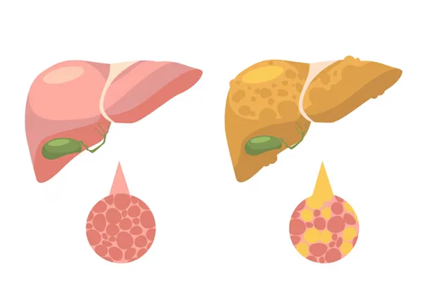 Chronic Liver Disease