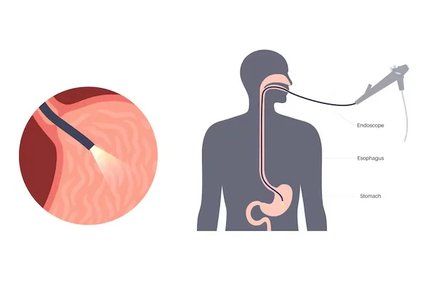 Endoscopy