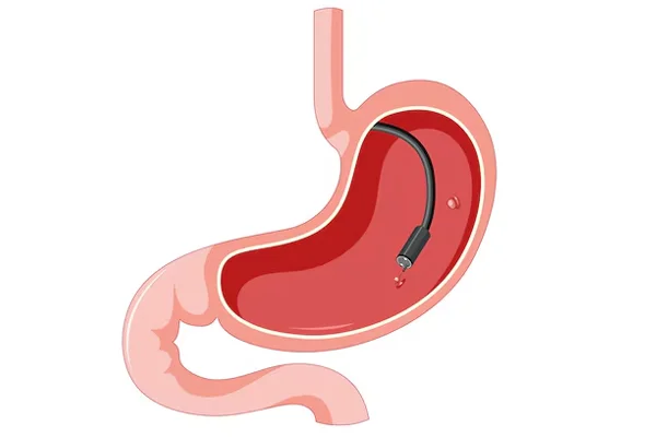 Polypectomy